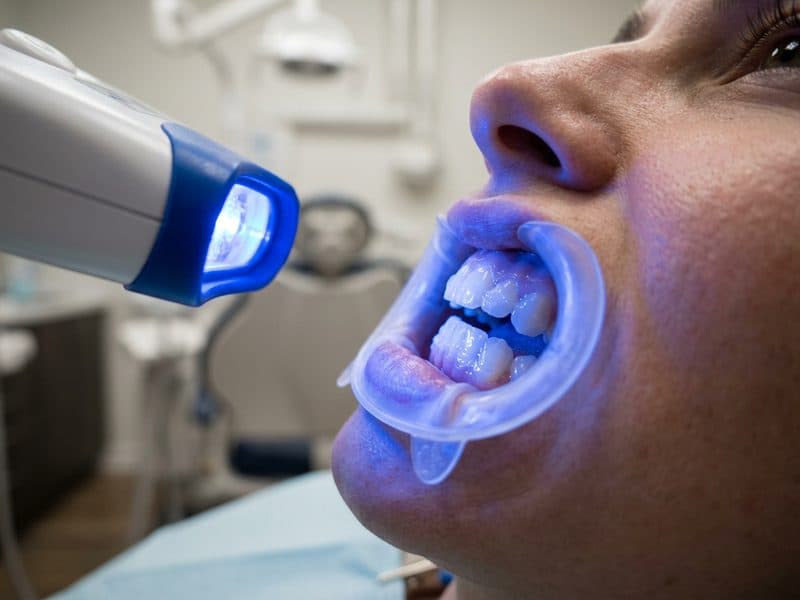 Blanqueamiento dental en Ortigueira, Sigüeiro y Cariño