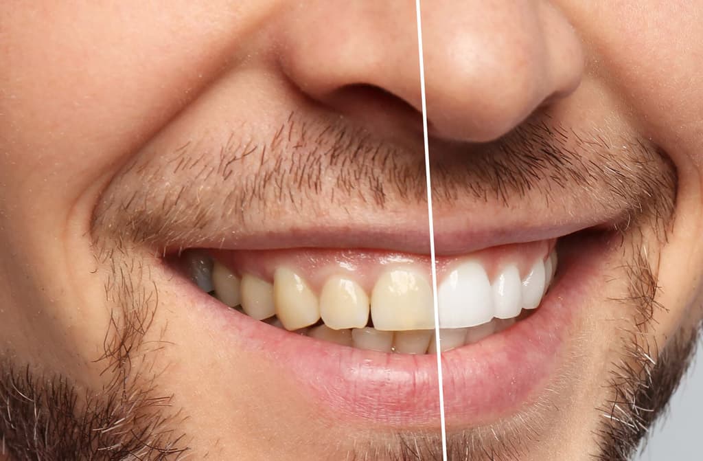 Blanqueamiento dental