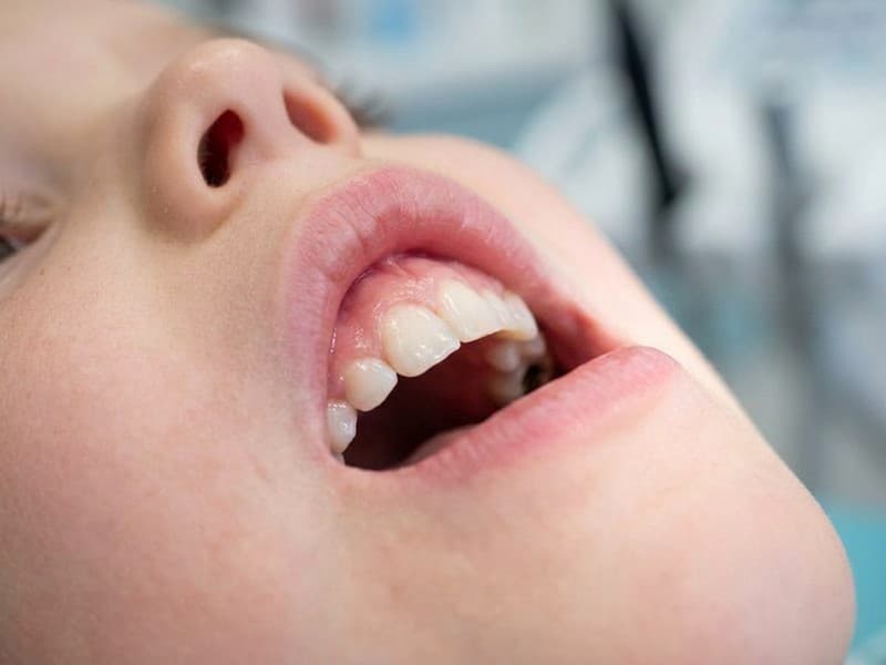 Tratamiento de caries infantil en Ortigueira, Sigüeiro y Cariño
