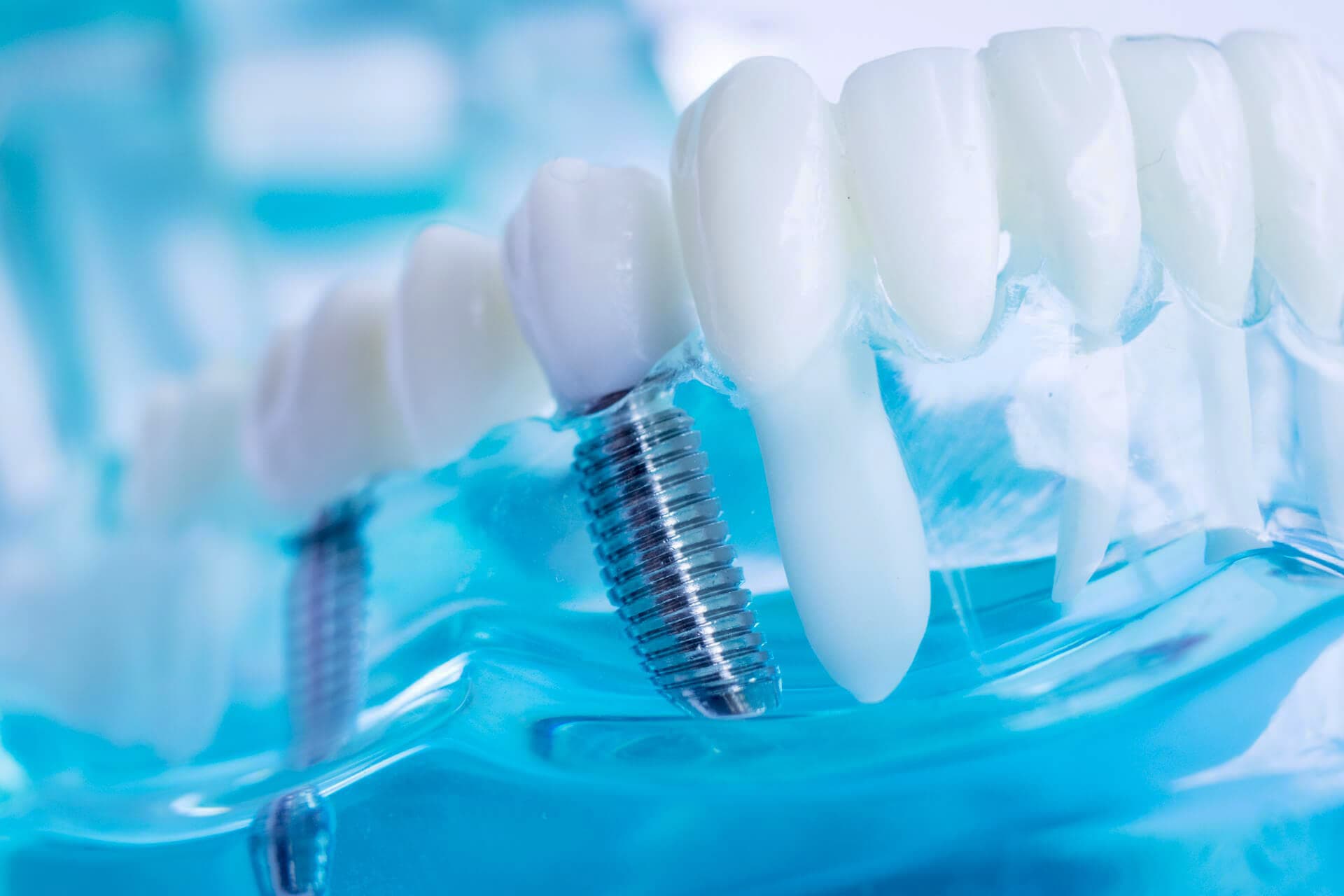 Implantes dentales en Ortigueira