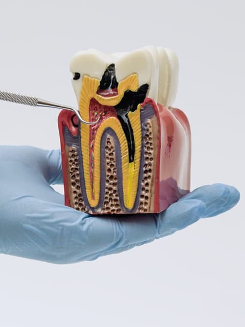 Especialistas en endodoncia en Ortigueira, Sigüeiro y Cariño
