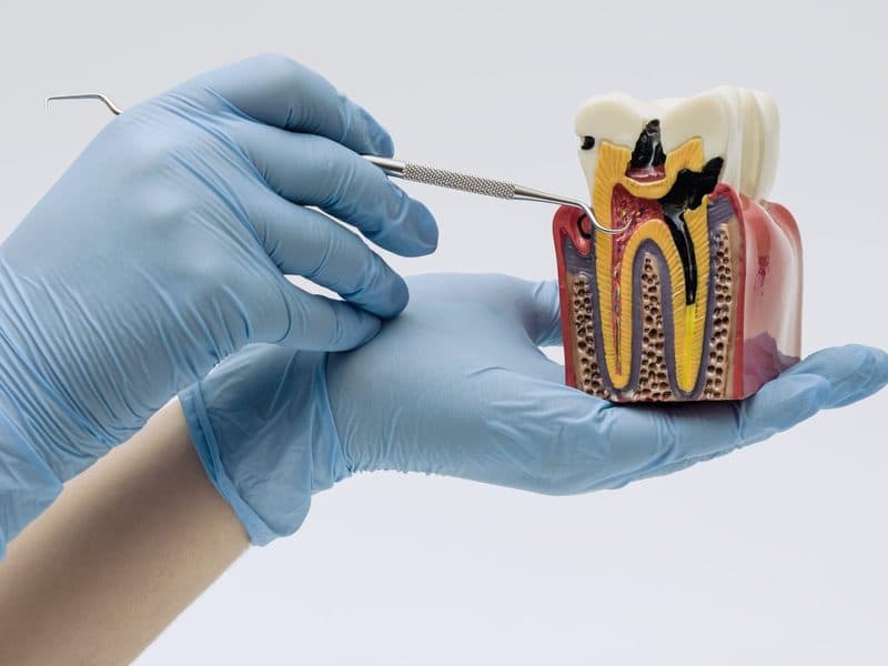 Endodoncia en Ortigueira, Sigüeiro y Cariño