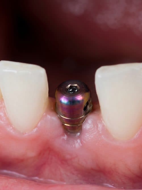 Implantología dental en Ortigueira, Sigüeiro y Cariño